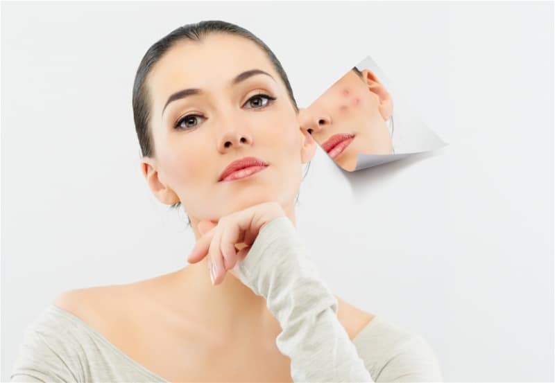 Anti-inflamatório para pele: Ômega 3 para melhora da acne